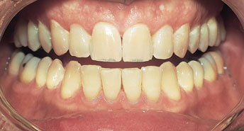 AgingBefore Whitening