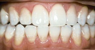 TetracyclineAfterWhitening