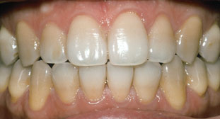 TetracyclineBefore Whitening