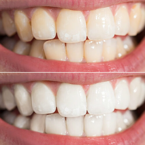Zoom Teeth Whitening at Fitzgerald Dentistry Zoom Teeth Whitening at Fitzgerald Dentistry